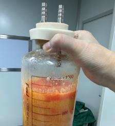 乐平水动力吸脂手术要做多久？